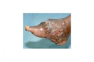 A human foot showing signs of infection with Madurella mycetomatis.