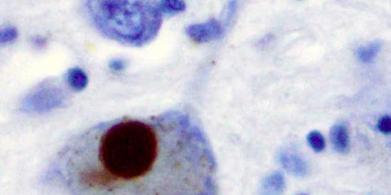Immunohistochemistry for alpha-synuclein showing positive staining (brown) of an intraneural Lewy-body in the Substantia nigra in Parkinson's disease.